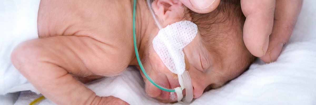 Neugeborenes mit Versorgungsschläuchen in dr Nase, Pflaster im Gesicht